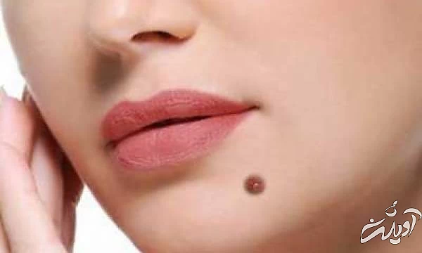 خال روی چانه